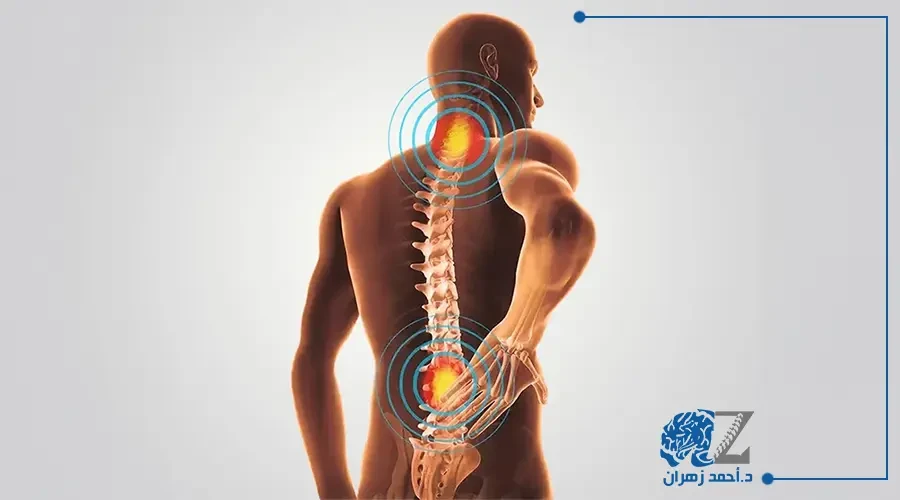 درجات الانزلاق الغضروفي