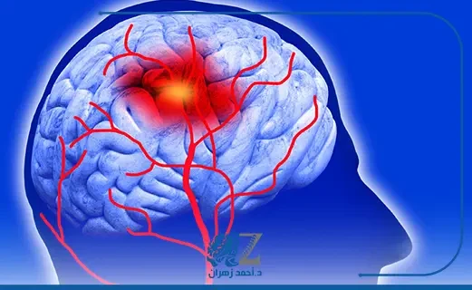 اعراض الجلطة الدماغية